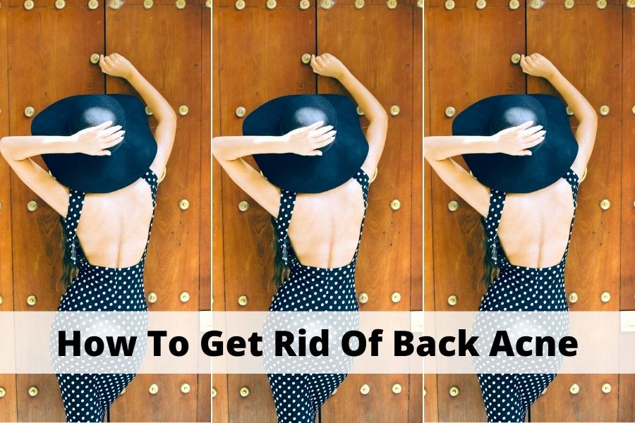 How to get rid of back acne fast